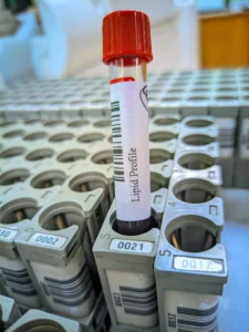 lipid profile test sample 