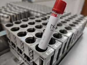 uric acid test sample