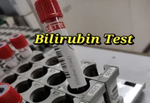 bilirubin test sample tube 