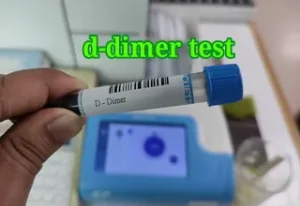 d-dimer test