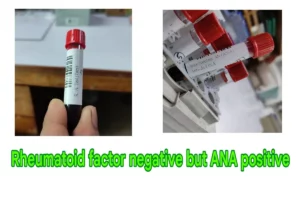 Rheumatoid factor negative but ANA positive