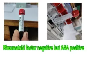 Rheumatoid factor negative but ANA positive