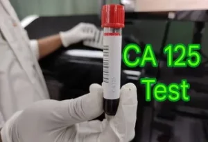 CA125 Test