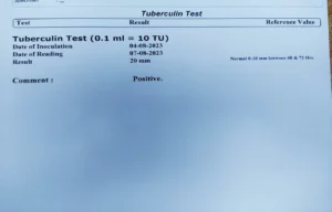 positive tb test results